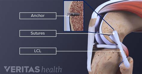 tests for lcl tear injury|does lcl tear require surgery.